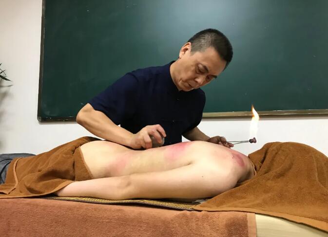 腰痛大多和濕邪有關 中醫拔罐能祛濕邪