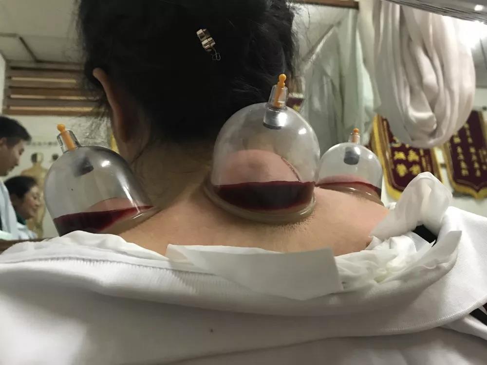 刺血療法對身體安全到底有沒有保障？